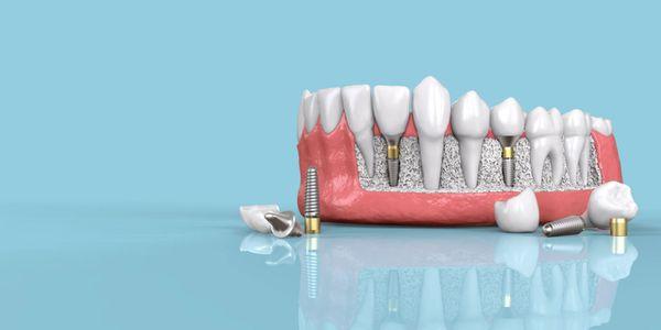 Dental Implant