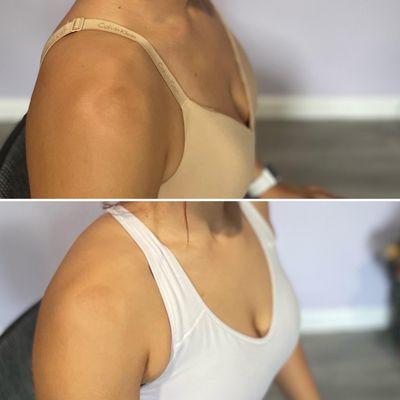 Chemical Peel on Scared Shoulder- (Top- Before) (Bottom-After)