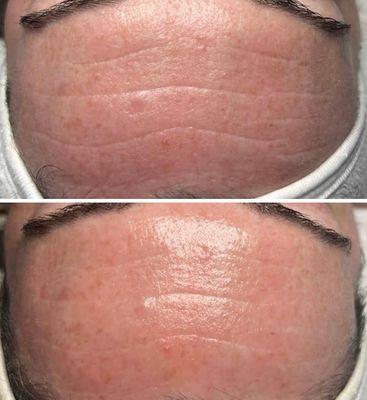 Pre and post chemical peel