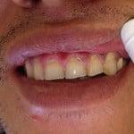 Actual patient, unretouched photo: BEFORE: Patient had many cavities on his front teeth, affecting his smile.