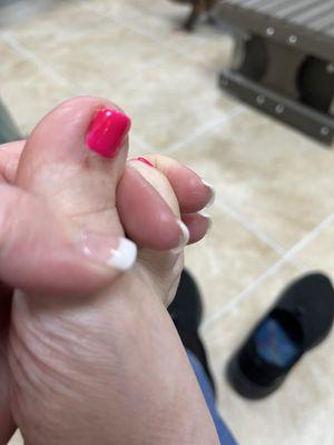 Bruised toe