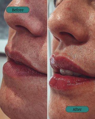 Before And After Lip Filler