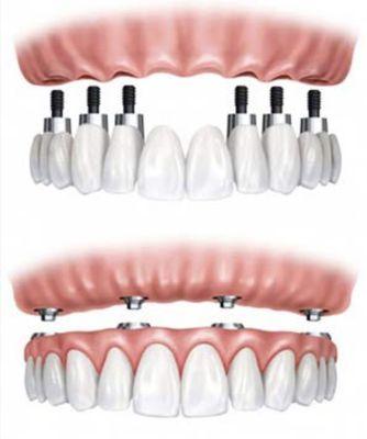 Full Implant Dentures