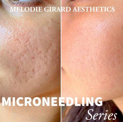 Microneedling series