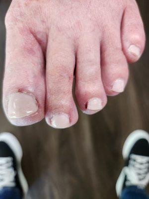 Big toe and middle toe still have sores.