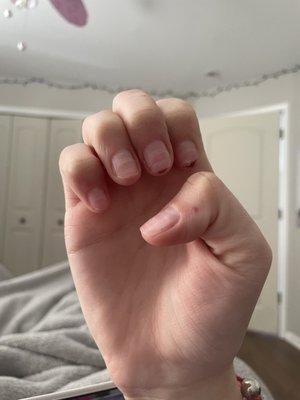 cuts from nail removal