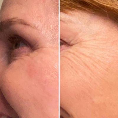 Results on left side after one Morpheus8 microneedling treatment by Lauren