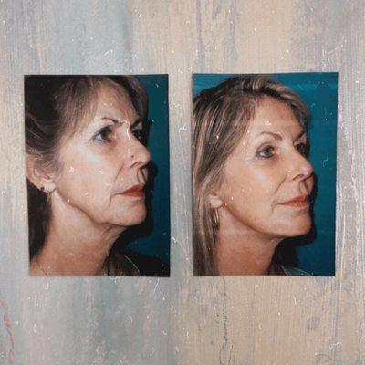 Dr. Hirschfeld offers cosmetic and corrective surgeries for face lifts, neck lifts, eyebrow lifts and many more options.