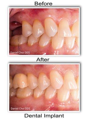 Dental Implant