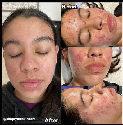 This could be you! Acne FREE! Take control of your acne in  3 Months! Learn more about Our Acne Program! Call Me Anytime at (714) 660-0700