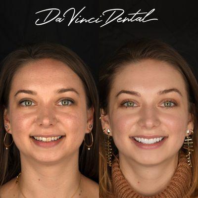 Distracting features of our patient's smile were eliminated with our World-class Veneers which allowed a new harmonious flow of beauty.