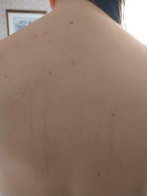 The scratches left by my painful massage. The bruises are still forming and didn't photograph well.