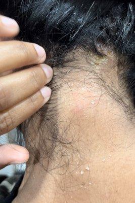 Scalp and Skin burn