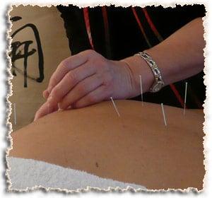 Acupuncture at Skagit Whole Health Center.