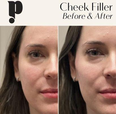 1cc of Cheek Filler by Samantha