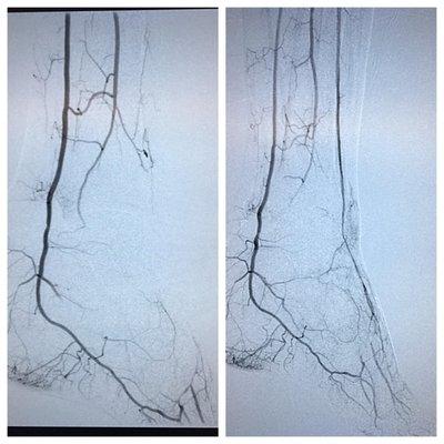 Revascularisation of anterior tibial artery. Treatment for Foot & Toe ulcers is accomplished by artherectomy.