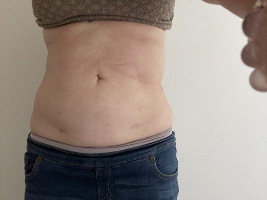 I have done liposuction with Wave. Please look at my result. I want them to fix it but they ask for more money.