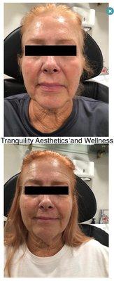 Botox before and 2 weeks after