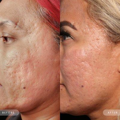 Acne Scar Combination Treatment Performed by Dr. Qazi!