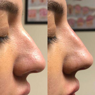 "Liquid nose job" using filler!