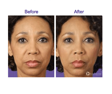 Juvederm