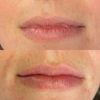 Before after lip filler