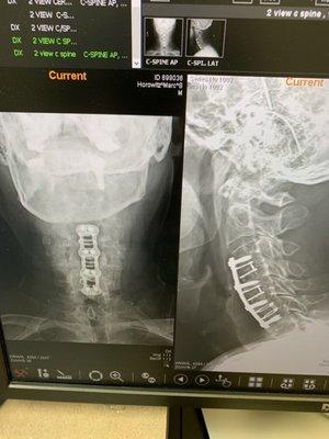 X-ray one year post post surgery for 3 level cervical spine decompression and fusion. Outstanding results! Surgeon Robert Norton