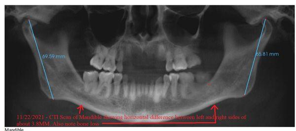 CTI scan showing bone loss at bottom, and horizontally misaligned bite by 3.8MM.