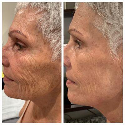 Photofacial and Profractional Laser Resurfacing