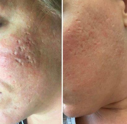 Fraxel -Before & after photos of Non ablative resurfacing for deep dermal Scarring, laser acne scars, ice pick scars, box car scars