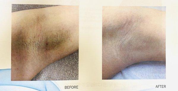 underarm hair removal