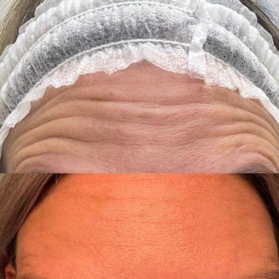 Anti-Wrinkle Treatment