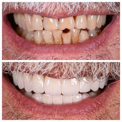 Anti-aging Smile makeover with veneers and crowns