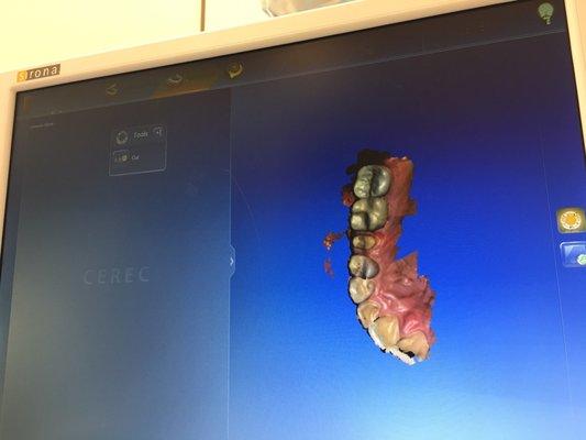 Cad of your teeth for precise fitting!