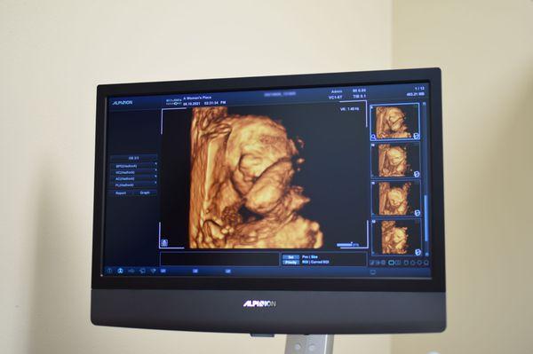 3D/4D Ultrasound