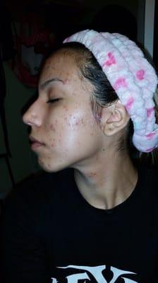 Very painful cystic acne