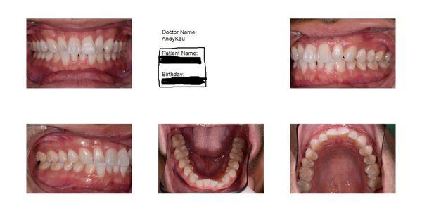 Invisalign Before