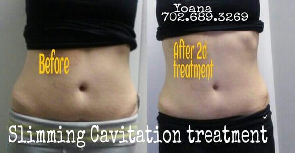 Non invasive, painless and safe slimming treatment. Instant results.