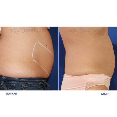 truSculpt 3D - One treatment for abdomen & flanks