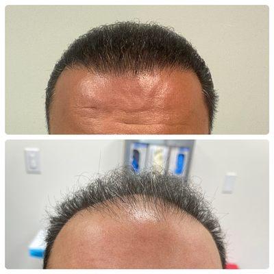 FUE Transplants Hairline Restoration