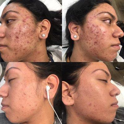 Helping our lovely client with her Cystic Acne