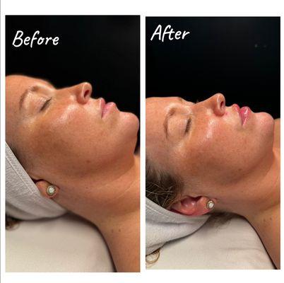 Before and after a Bespoke Facial with face lifting massage techniques!