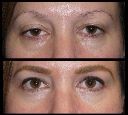 Before and after Ptosis repair, upper, and lower blepharoplasty on both eyes.