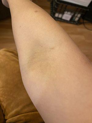 The blood draw was very painful, resulting in significant bruising.