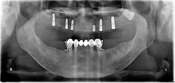 Upper jaw reconstruction with implants