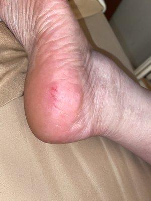 outside of left heel