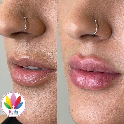 Lip Filler and Botox treatments in Riverside California