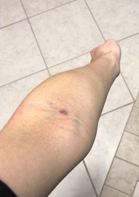 After 1 night, no bruises, only red spot.  Not bad :) Experienced 1 month bruise due to non-skilled person before so I appreciate this