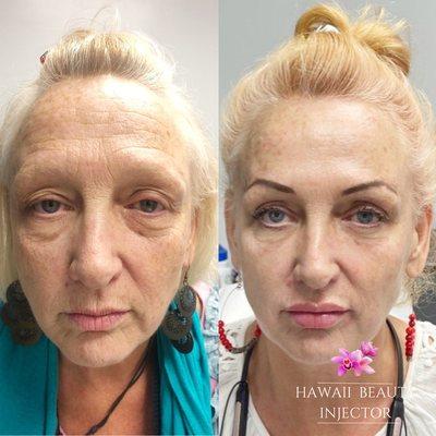 Full face rejuvenation- 1 year apart. Combined injectables and laser treatments