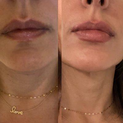 Lip enhancement using Juvaderm ULTRA XC filler.